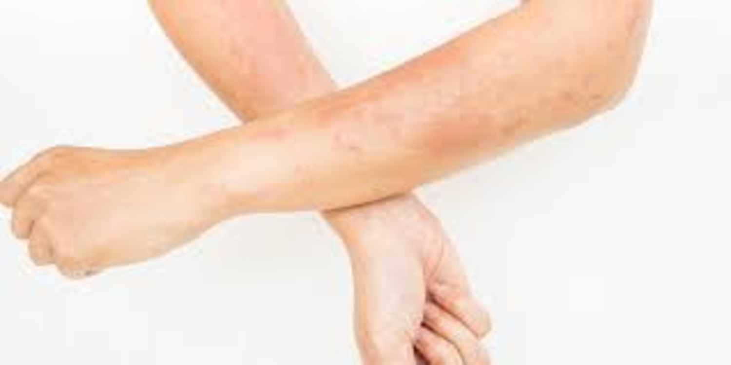 How to Get Rid of Contact Dermatitis Fast