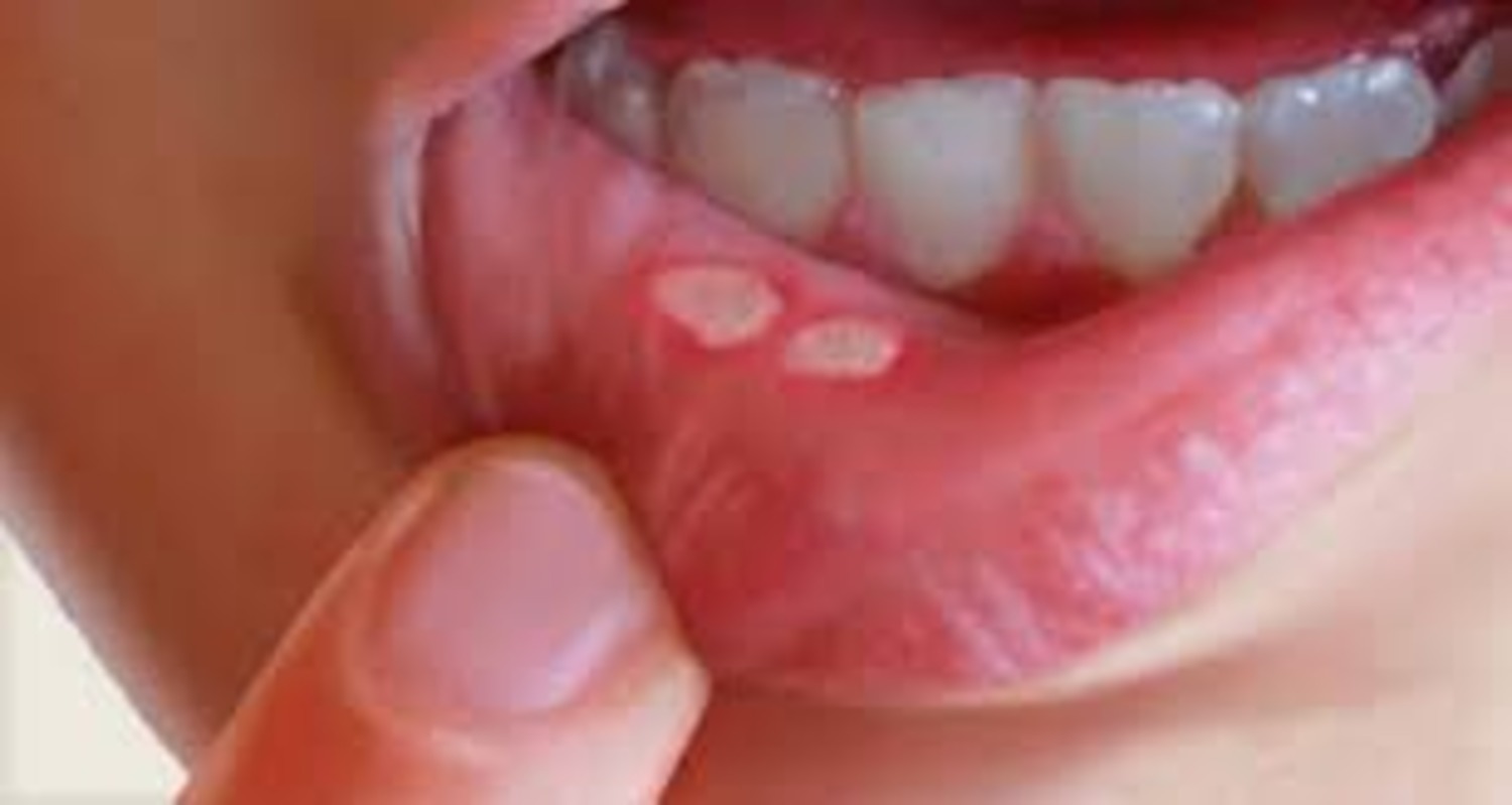 How to Get Rid of a Canker Sore in 24 Hours